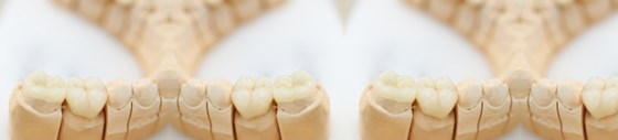 Teeth Whitening: Boston Dental